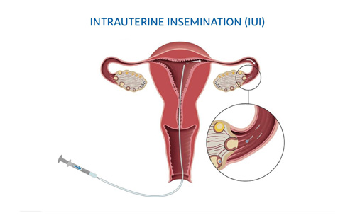 Intrauterine Insemination (IUI)