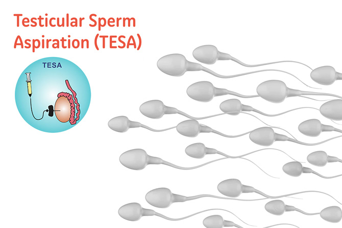 Role of TESA in helping conception with azoospermia