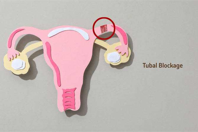 Pathways to Parenthood: Understanding and Overcoming Tubal Blockages