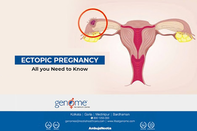 Ectopic Pregnancy – All you Need to Know